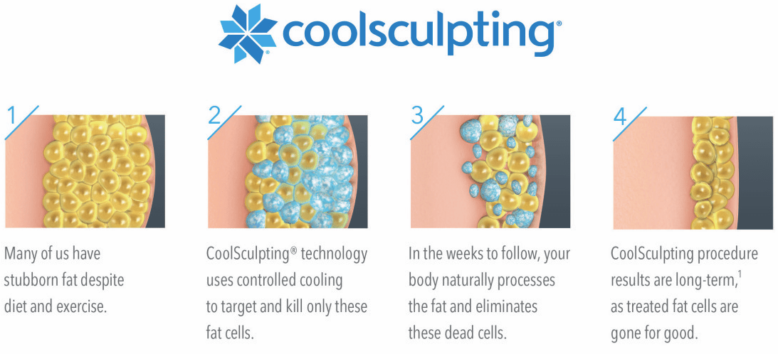 Coolsculpting może pomóc ograniczć cellulit